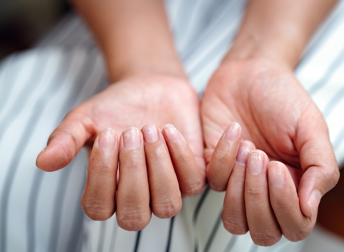 6 Indicators of an Iron Deficiency You Ought to By no means Ignore