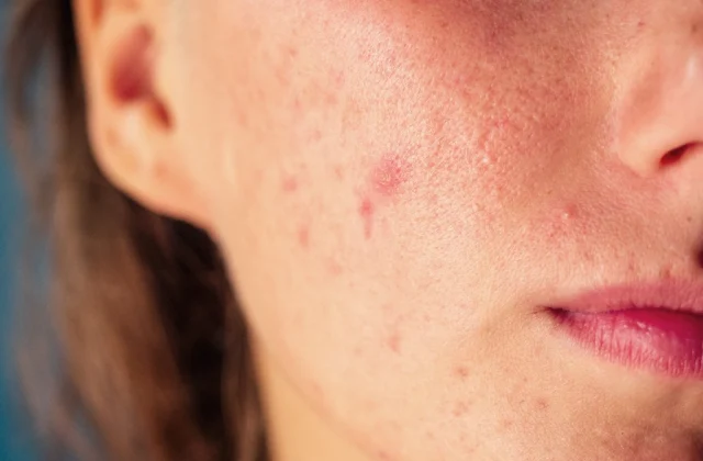 10 Meals Making Your Zits Even Worse