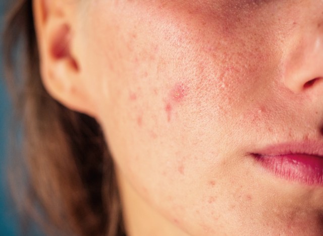 woman with problem skin