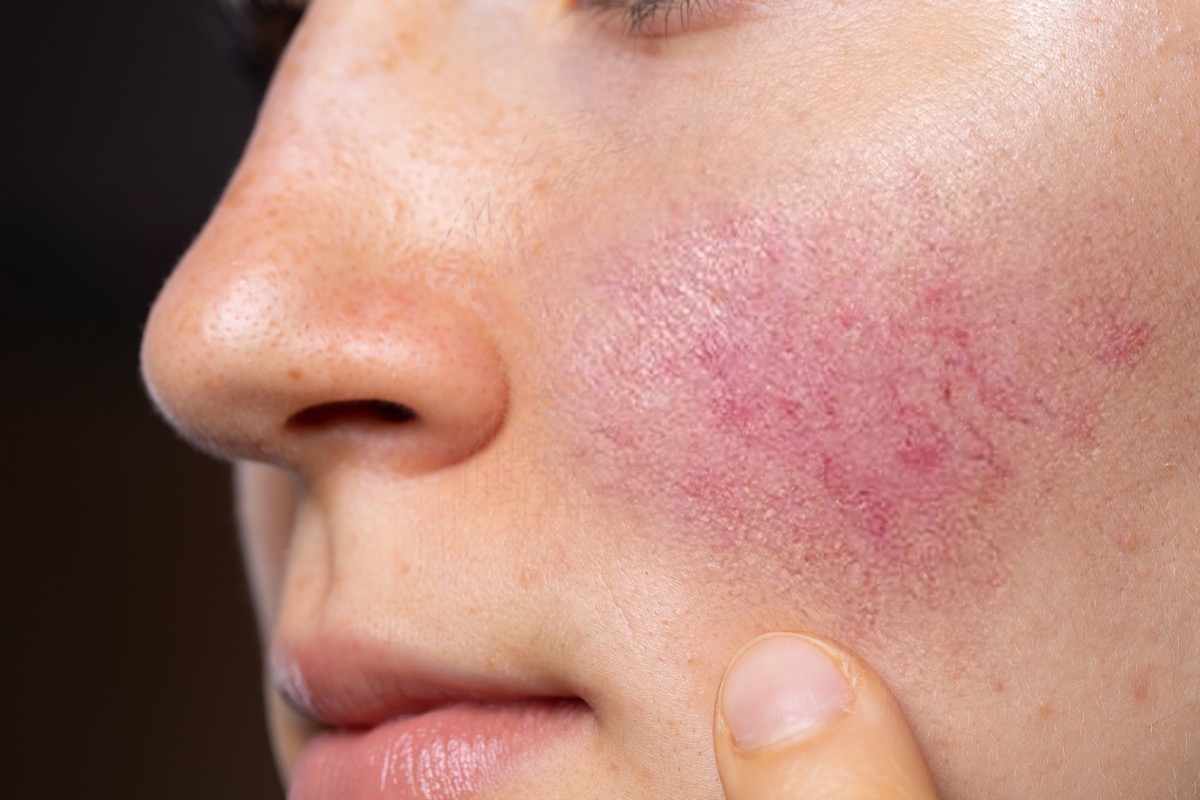 the #1 reason you shouldn't be drinking wine every day 20 woman with rosacea on cheeks