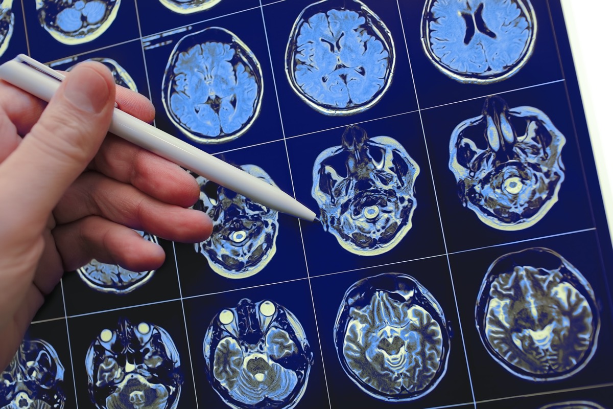 doctors pointing the pen at brain problems at the mri study results