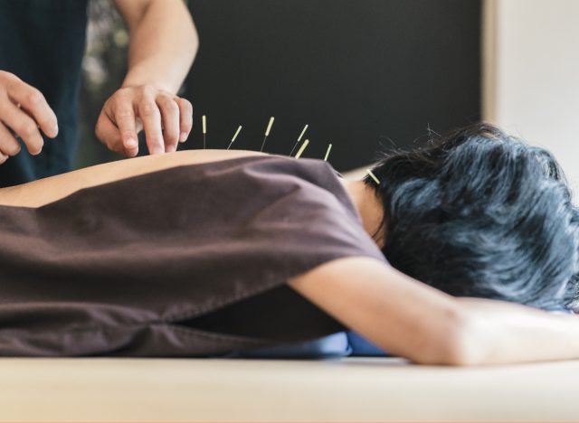 woman getting acupuncture on her back on the table