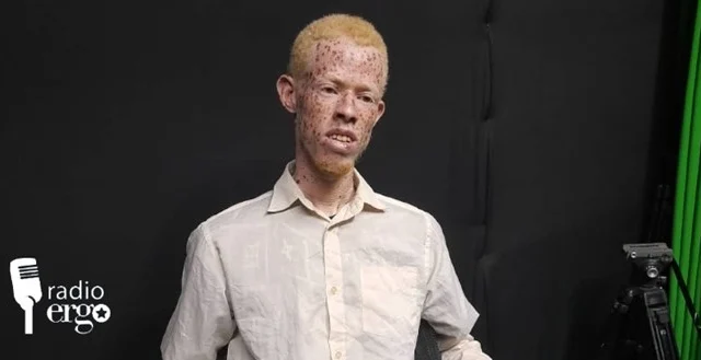Employment Enables a Young Somali Albino to Triumph Over Prejudice