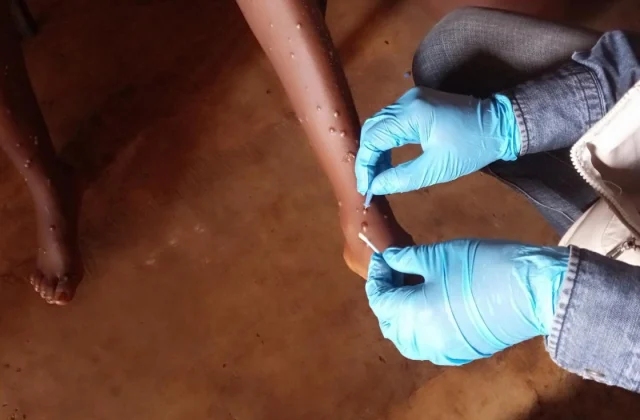 Nigeria, DR Congo, and Burundi Among the Hardest Hit by Mpox Epidemics
