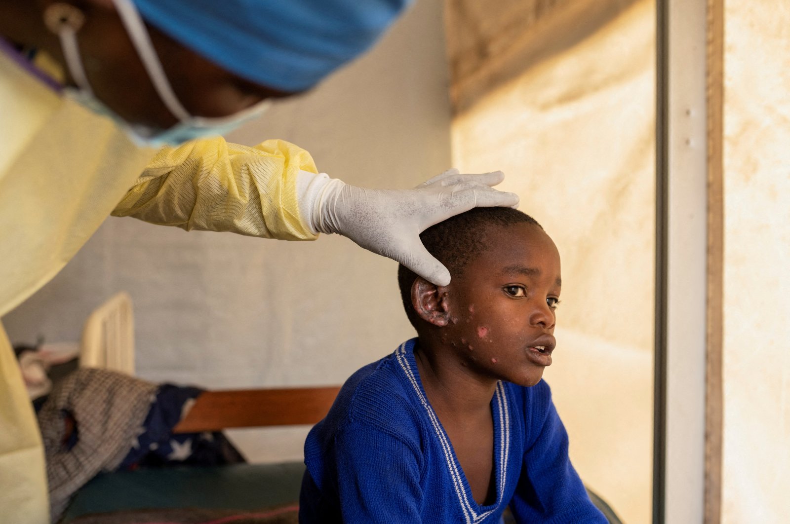 Sweden confirms first case of deadly mpox strain