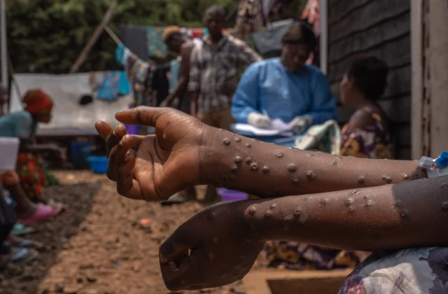 Africa Issues Warning: Mpox Epidemic Remains Uncontrolled