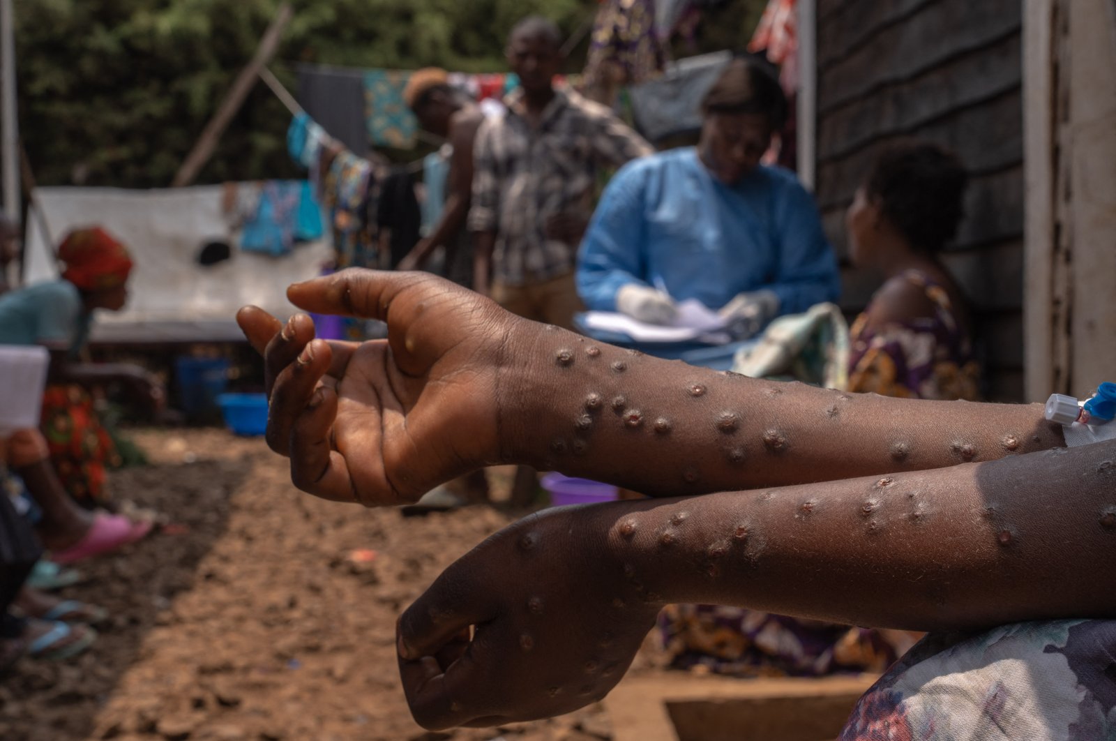 Africa warns epidemic 'not under control' as mpox
